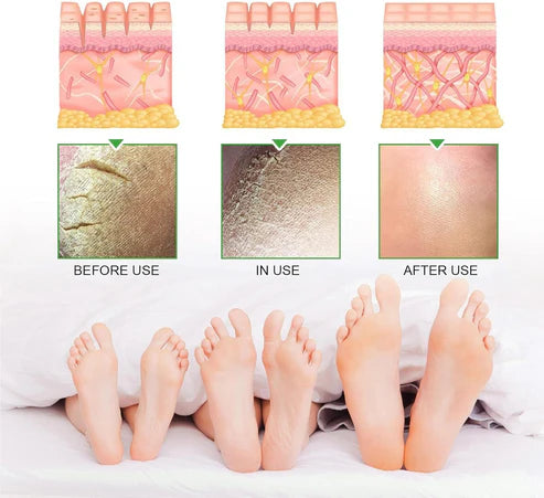 South Moon - 42% Urea Cream + 2% Salicylic Acid (Original)